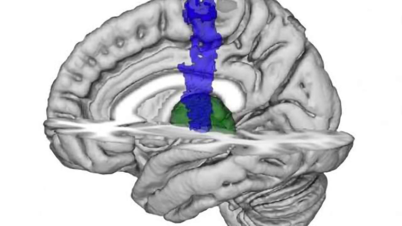 Some patients in a vegetative state retain awareness, despite being unable to move