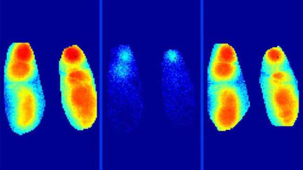 Alzheimer’s disease: Plaques impair memory formation during sleep