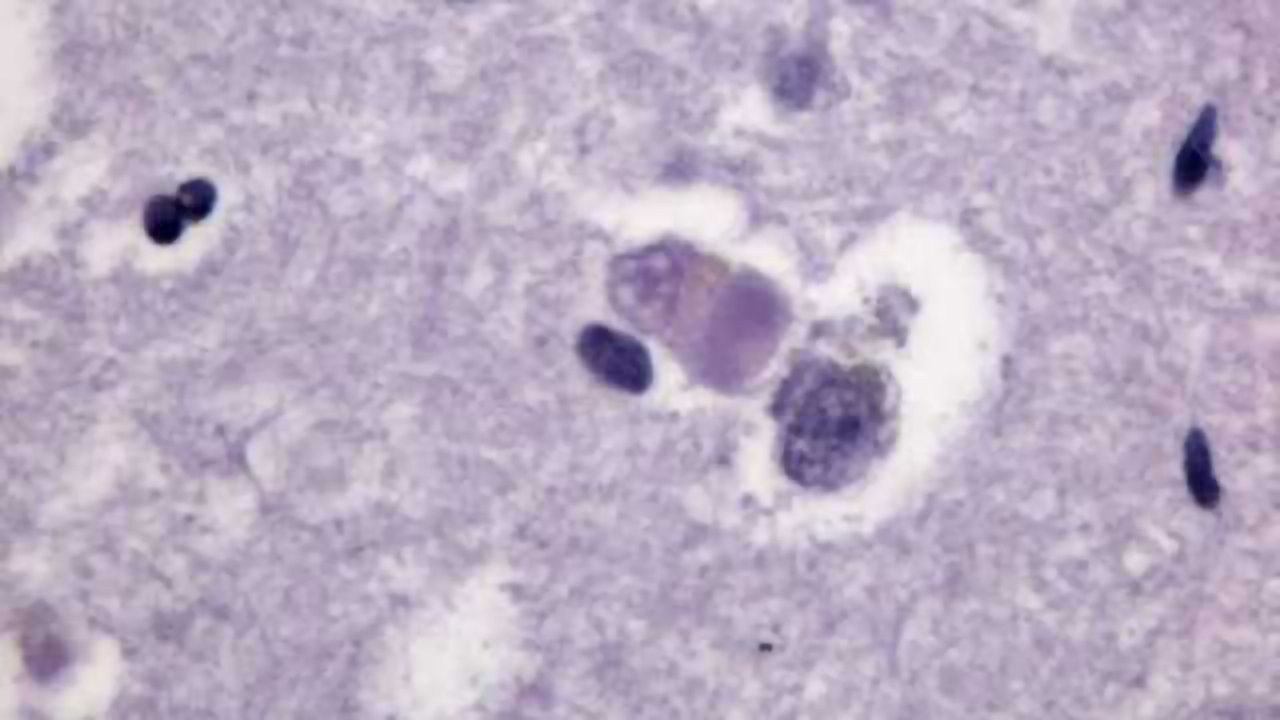 Three-minute test detects common form of dementia that's hard to diagnose