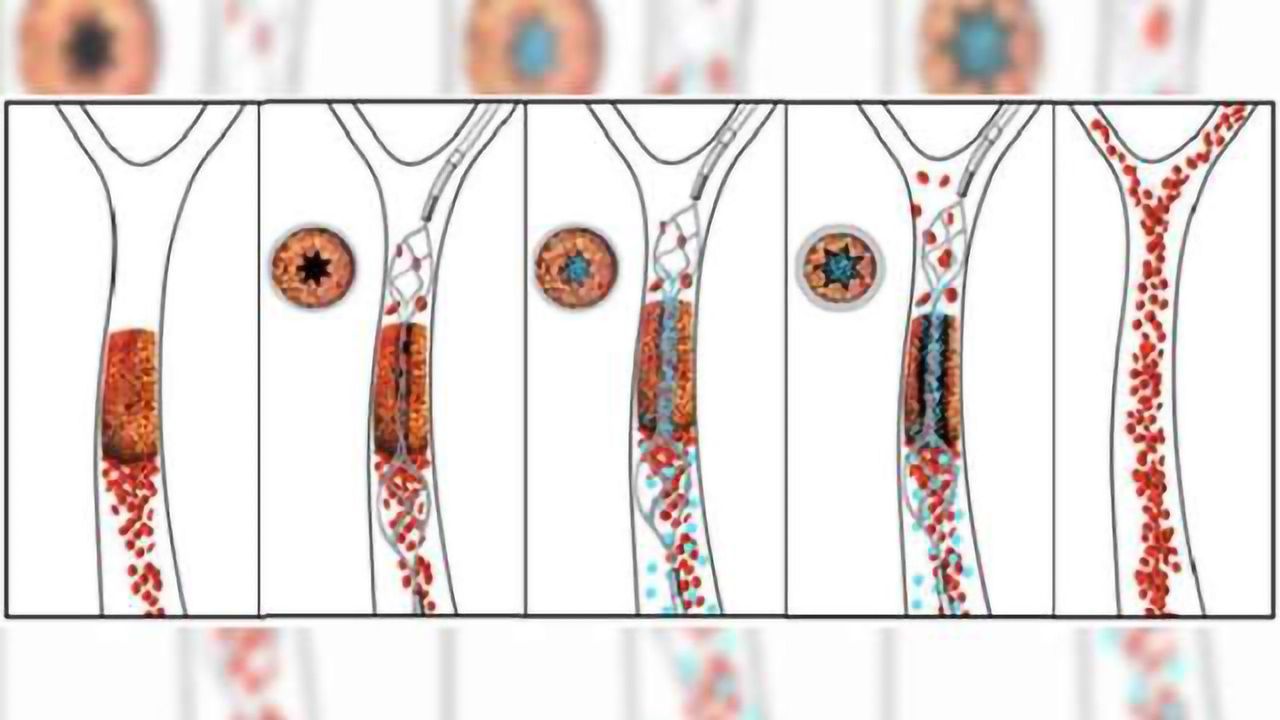 Drug-device combination opens potential new path to treat stroke