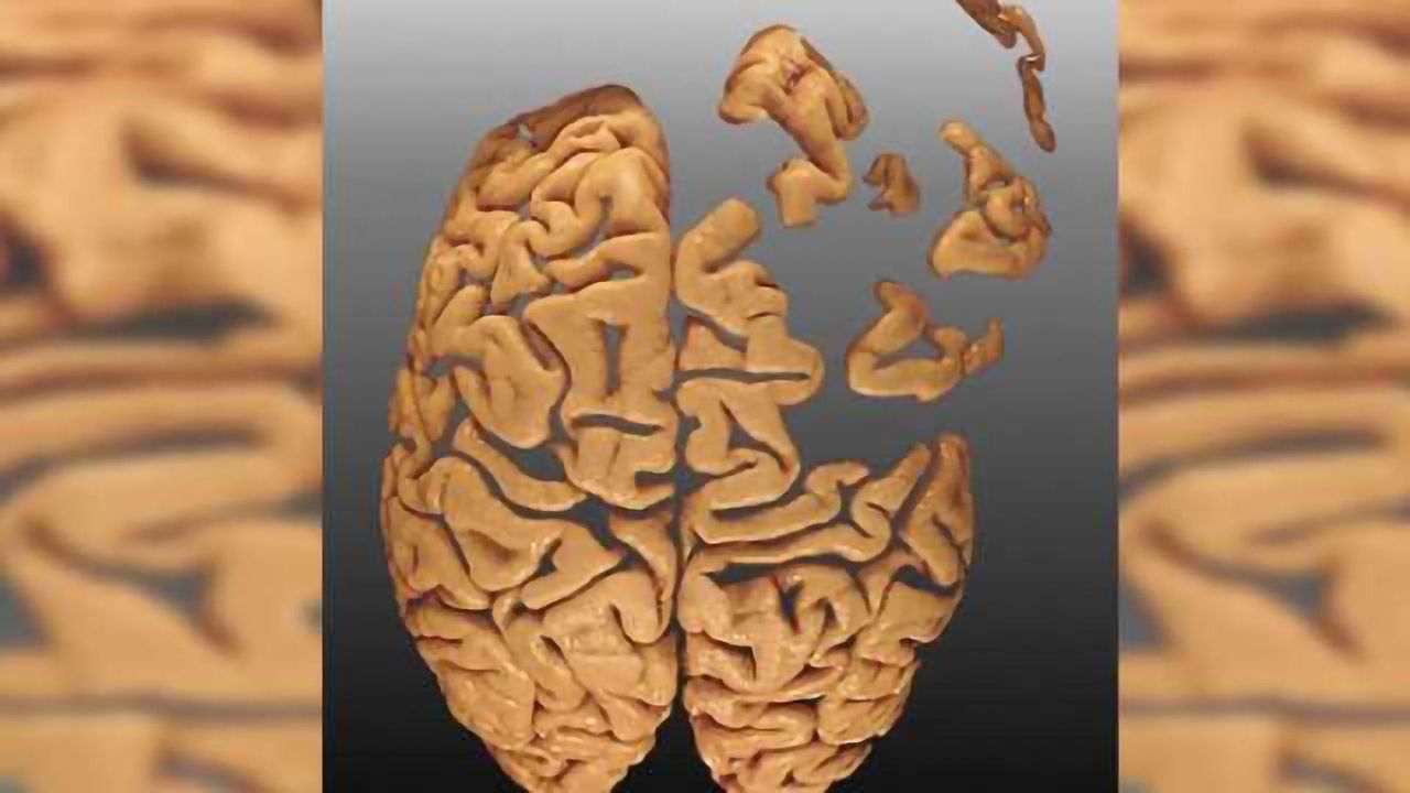 Righting a wrong? Right side of brain can compensate for post-stroke loss of speech