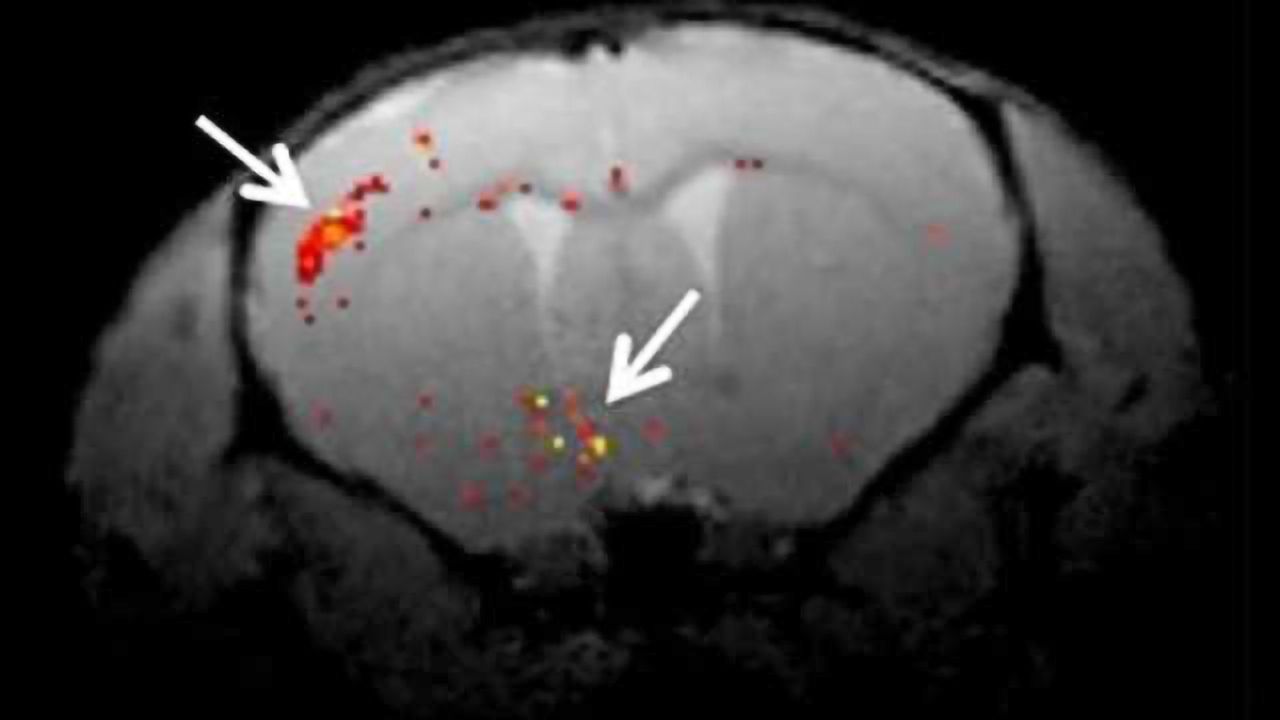 Eye drops deliver gene therapy for brain disorders in NIH mouse study