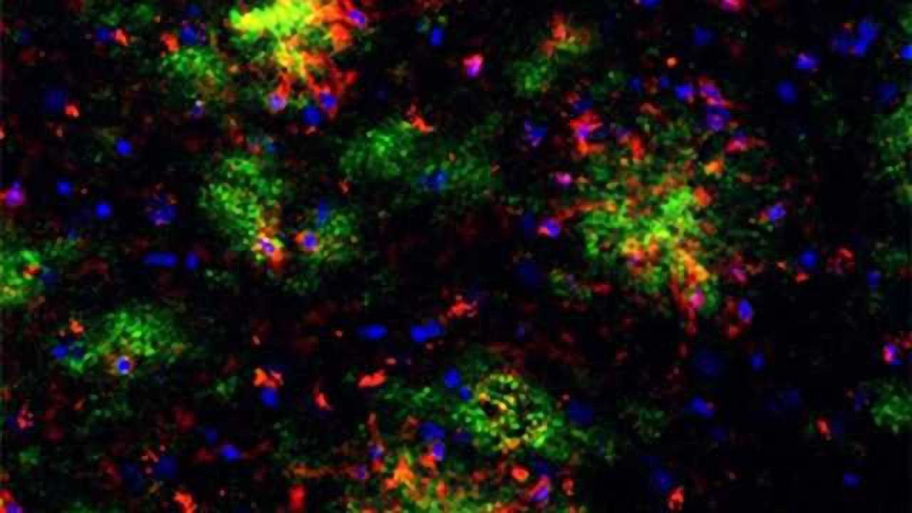 Possible solution for side effect of Alzheimer’s immunotherapy treatment