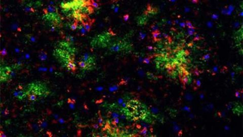 Possible solution for side effect of Alzheimer’s immunotherapy treatment