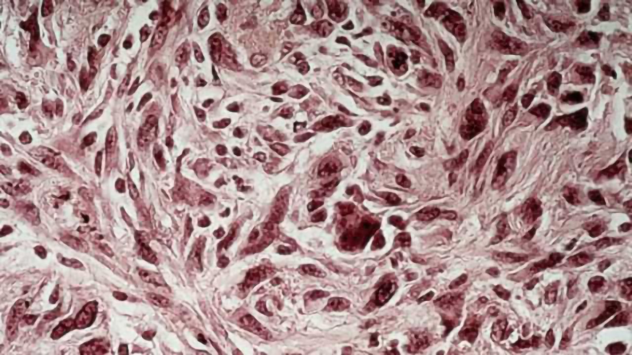 Tumour network in the brain increases treatment resistance