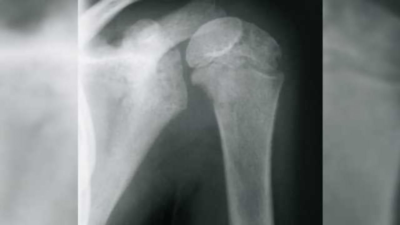 Promising results reported in study of pediatric neuroblastoma