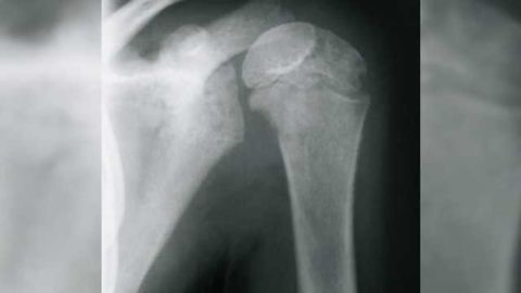 Promising results reported in study of pediatric neuroblastoma