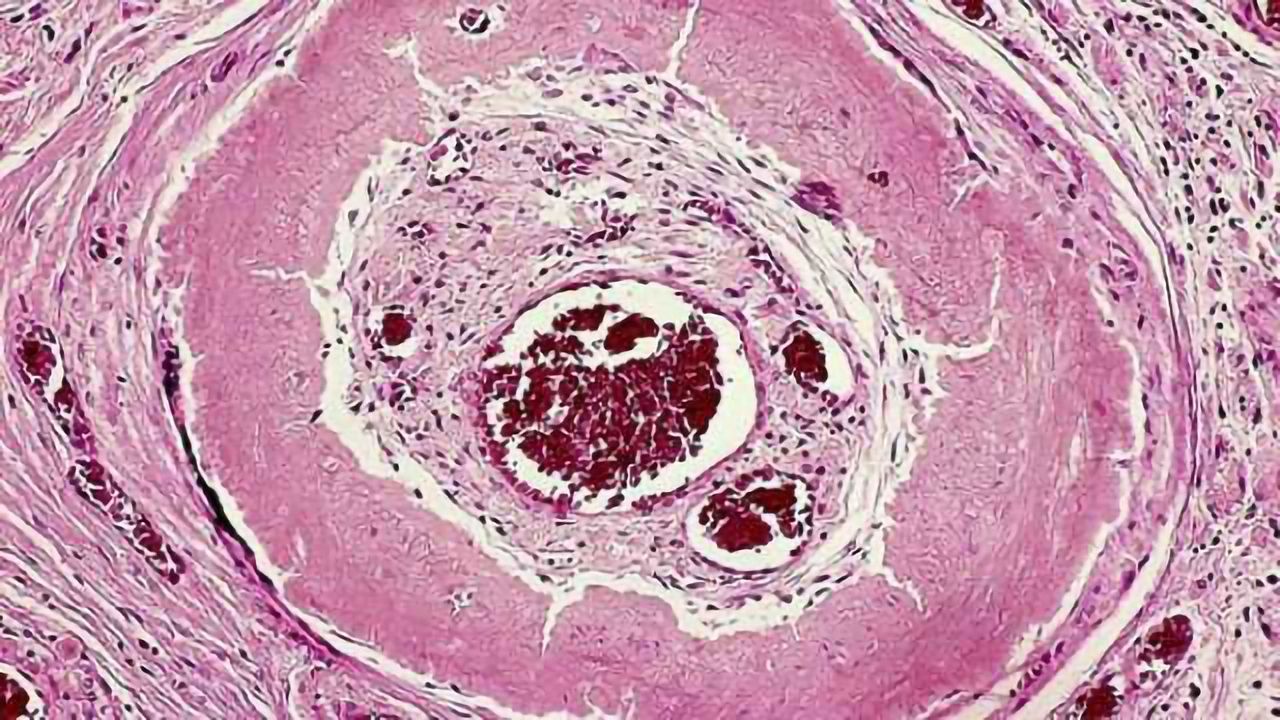 Molecular mechanism at root of familial amyloidosis and other diseases