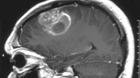 Drug identified that could limit the spread of deadly brain tumors
