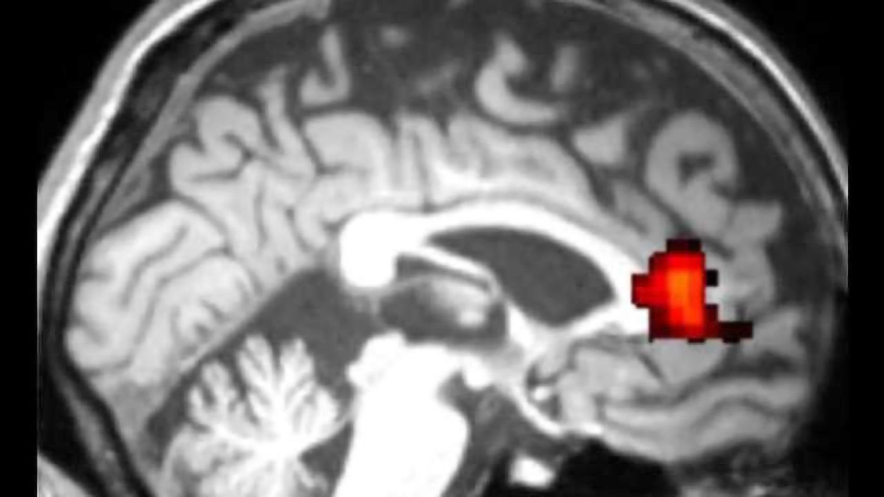 Brain scan reveals cognitive deficits in older 'cognitively normal' individuals living with HIV