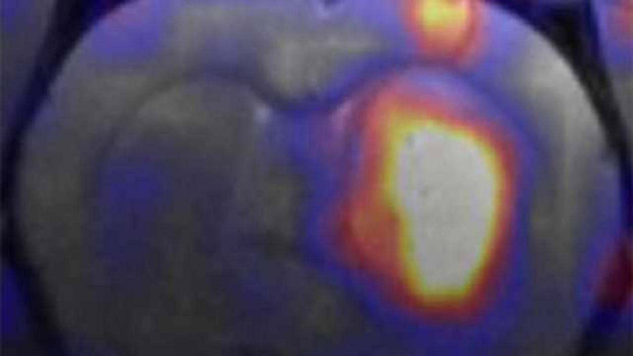 Nanocarriers may carry new hope for brain cancer therapy