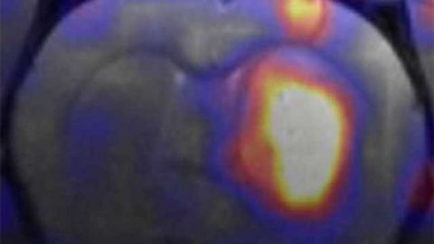Nanocarriers may carry new hope for brain cancer therapy