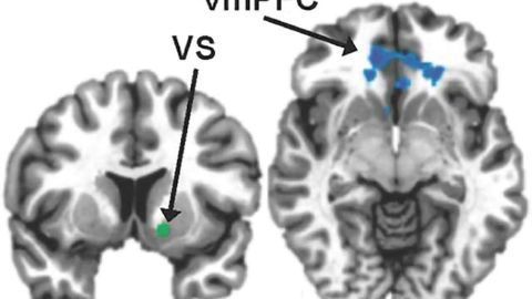 Inflammation linked to weakened reward circuits in depression