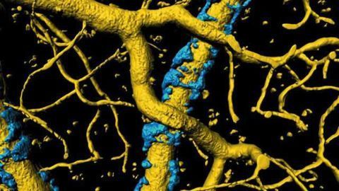 Insight into cause of Alzheimer's symptoms: Amyloid plaques may be strangling blood flow