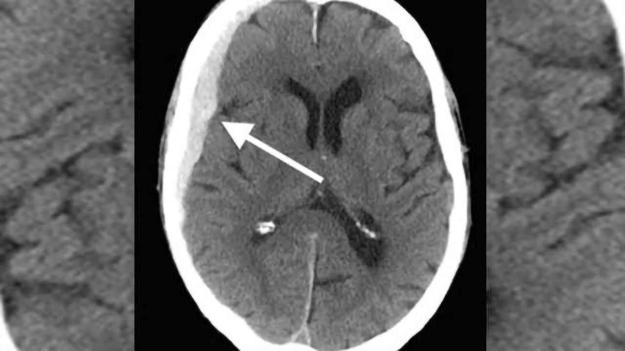 Even the elderly can recover from a severe traumatic brain injury