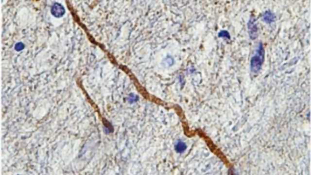 "Mild traumatic brain injury an oxymoron:" Protein biomarker highlights damaged brain wiring after concussion, study finds