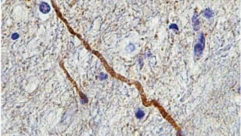 "Mild traumatic brain injury an oxymoron:" Protein biomarker highlights damaged brain wiring after concussion, study finds
