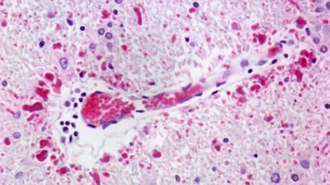 Tracing a path toward neuronal cell death