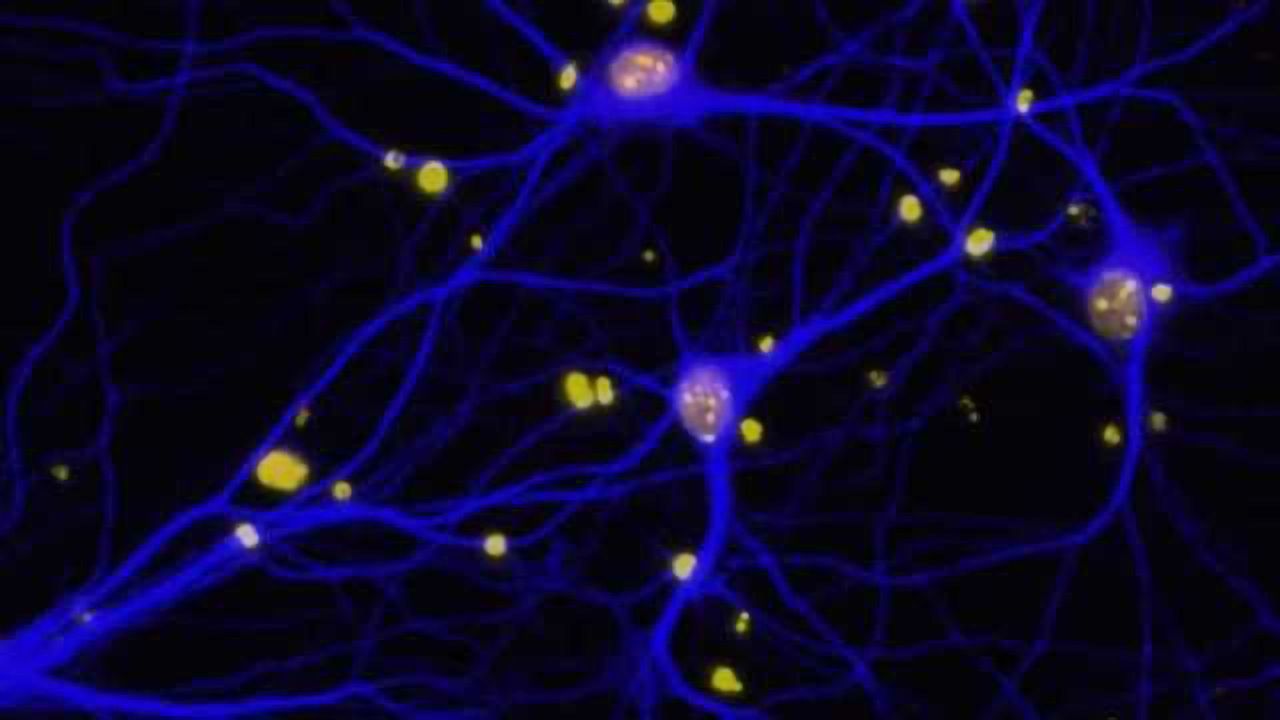 DNA repair factor linked to breast cancer may also play a role in Alzheimer's disease