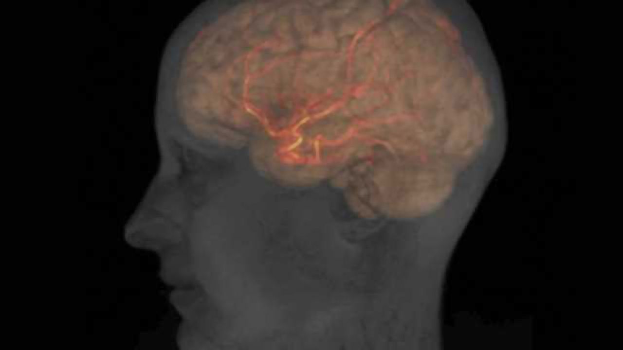 Reduced blood flow seen in brain after clinical recovery of acute concussion