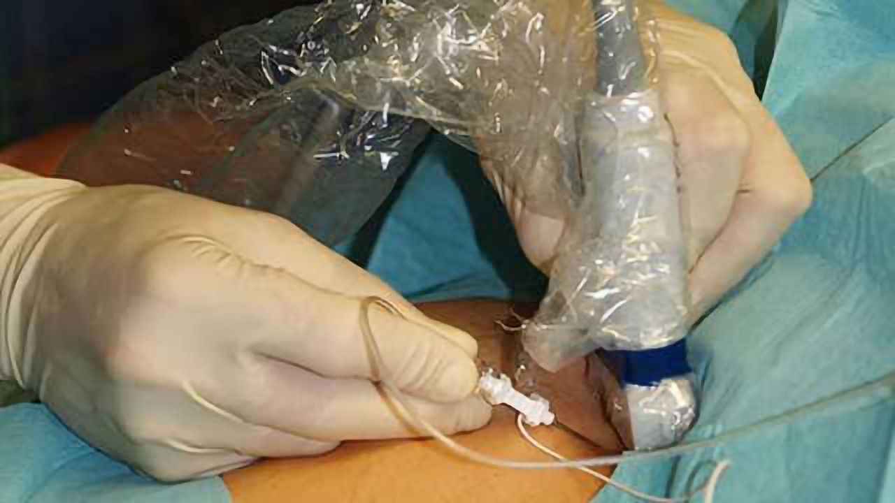 Method of postoperative pain relief may influence recovery from total knee replacement surgery