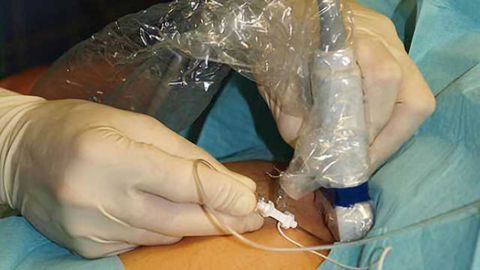 Method of postoperative pain relief may influence recovery from total knee replacement surgery