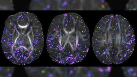 Prenatal maternal iron intake shown to affect the neonatal brain