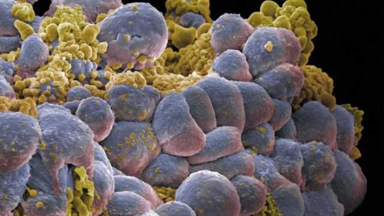 Researchers isolate cells implicated with breast cancer-derived brain tumors