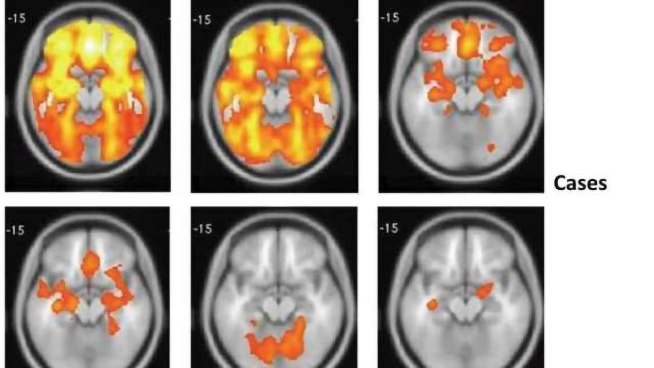 Biomarkers outperform symptoms in parsing psychosis subgroups