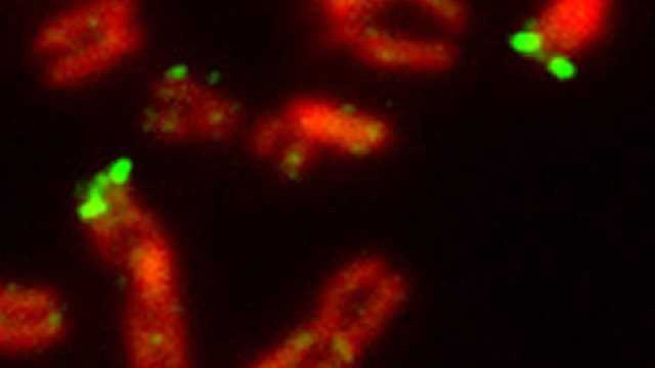 Discovery of X-linked intellectual disability syndrome is aided by web tools