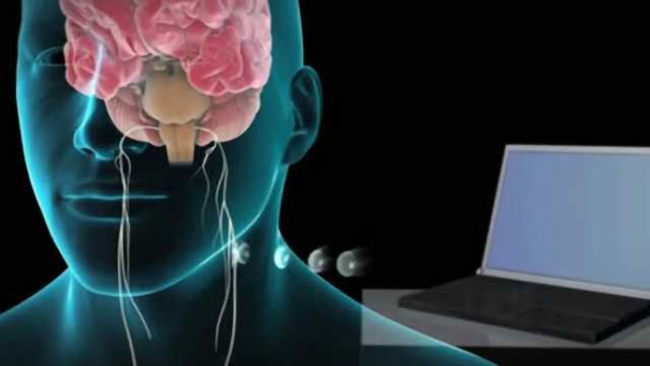 Vagus nerve stimulation shows progress in stroke patient recovery