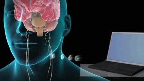 Vagus nerve stimulation shows progress in stroke patient recovery
