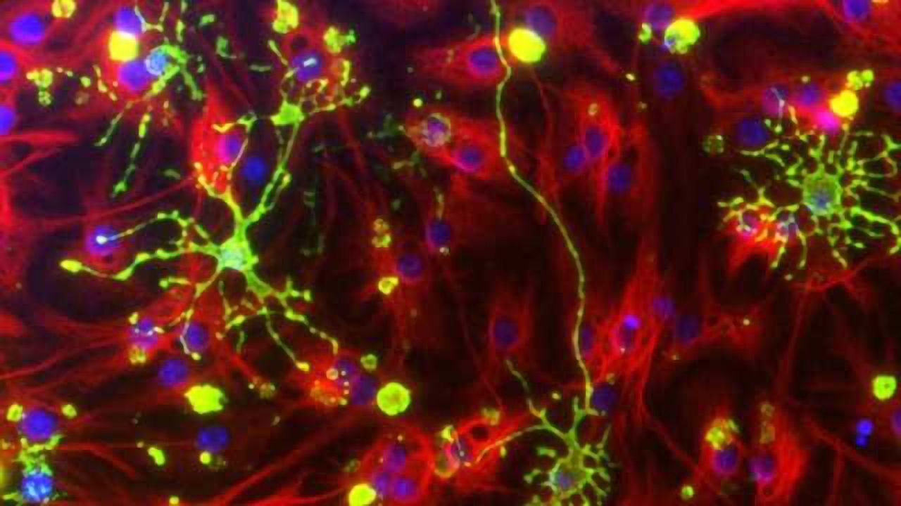 Geometric study of brain cells could change strategies on Alzheimer's