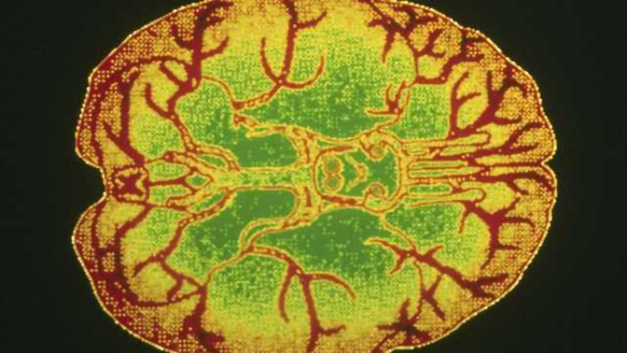 Treatment associated with changes in brain activity in borderline personality disorder