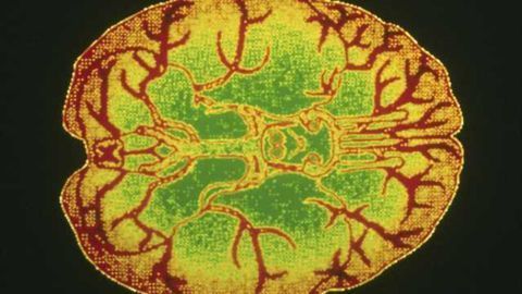 Treatment associated with changes in brain activity in borderline personality disorder