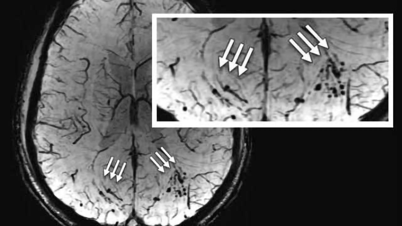 MRI shows 'brain scars' in military personnel with blast-related concussion