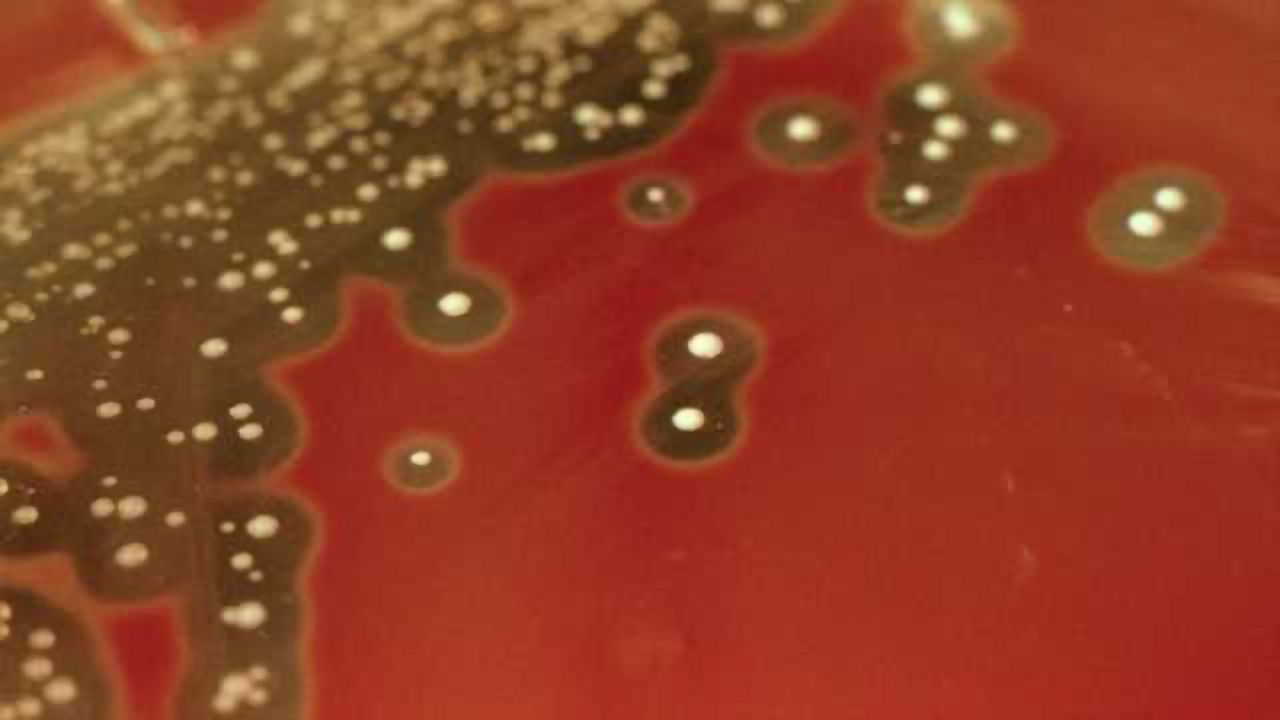 How recurrent Strep A infections affect the brain