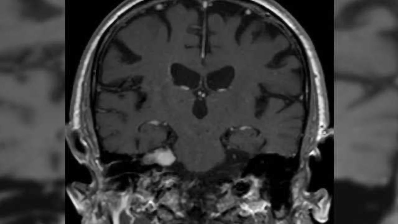 Toxic secretions from intracranial tumor damage the inner ear