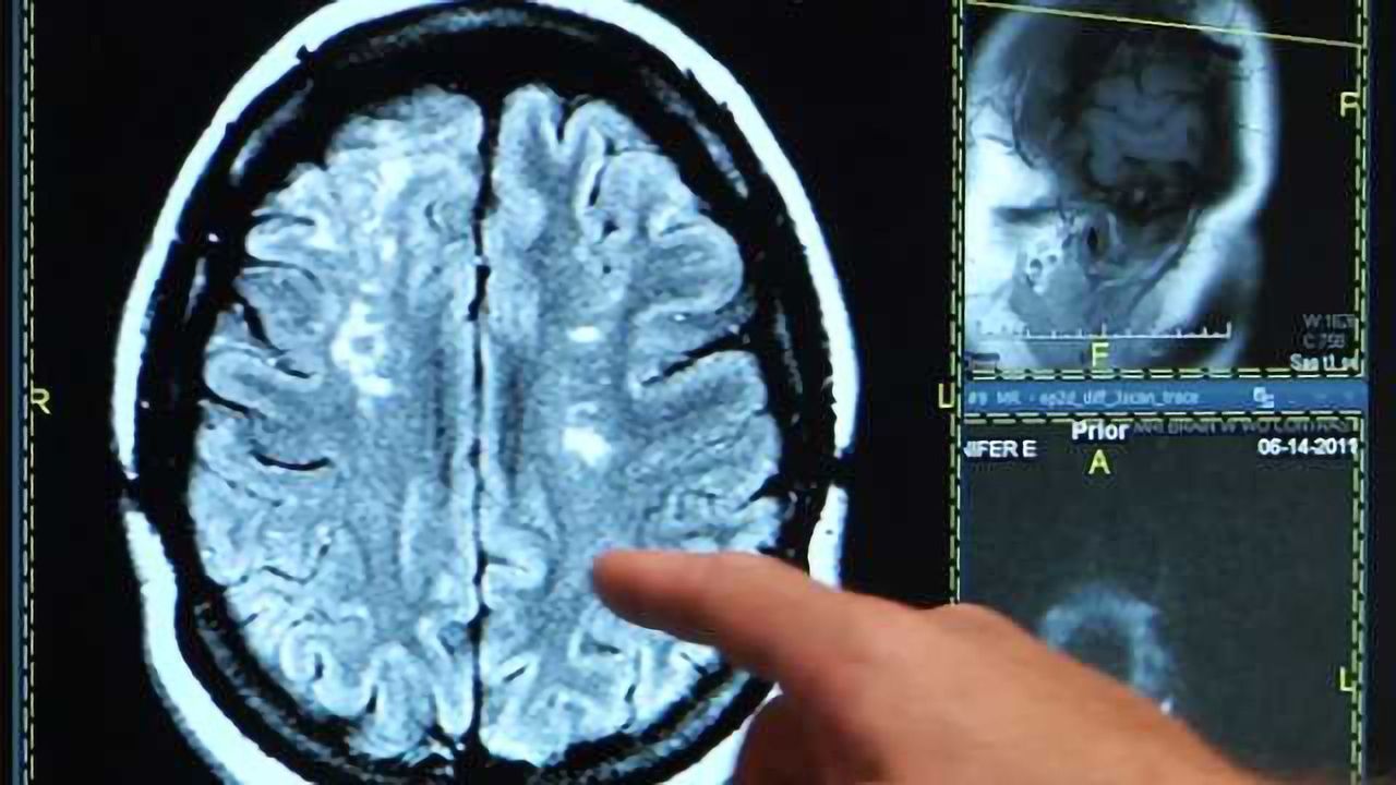 Survey finds most young people experiencing the signs of a stroke would put off going to the E.R.