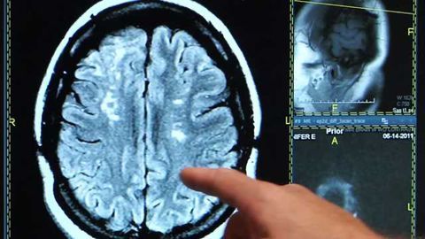 Survey finds most young people experiencing the signs of a stroke would put off going to the E.R.