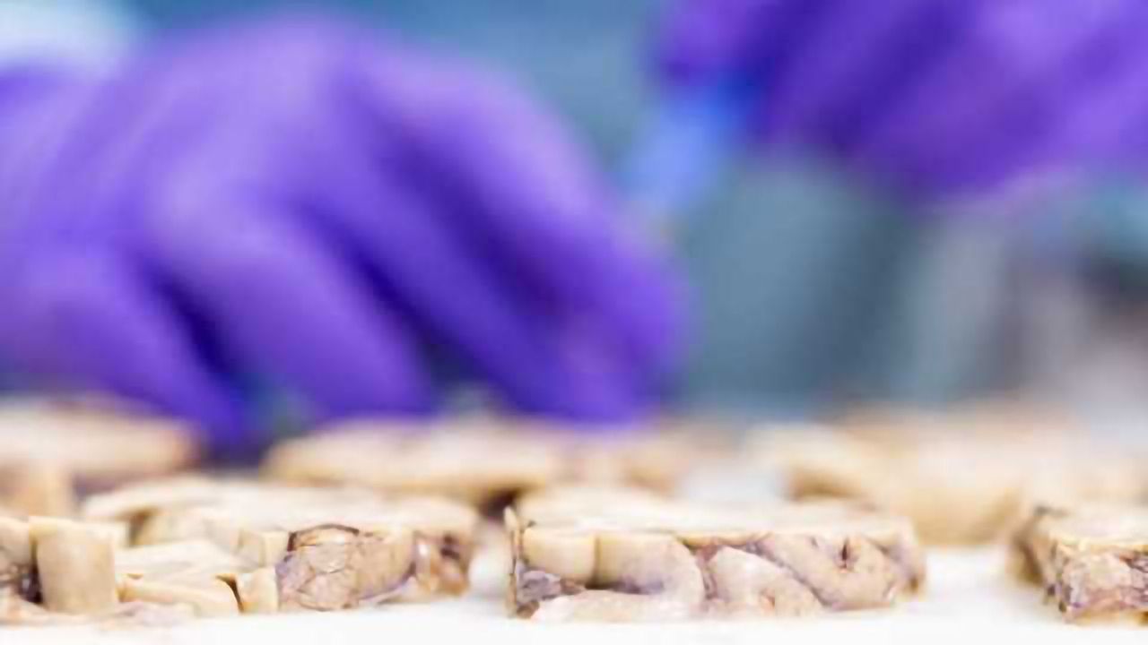 Researchers discover novel factor in Parkinson's disease