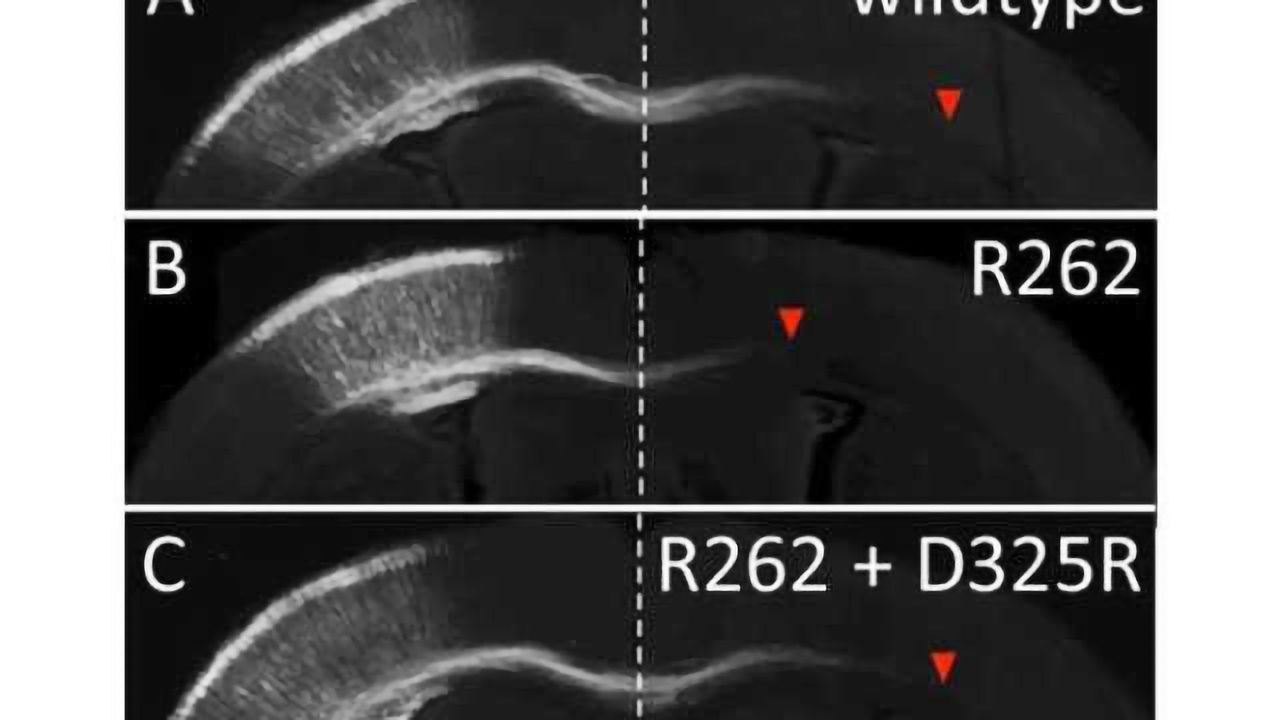 Thwarting abnormal neural development with a new mutation