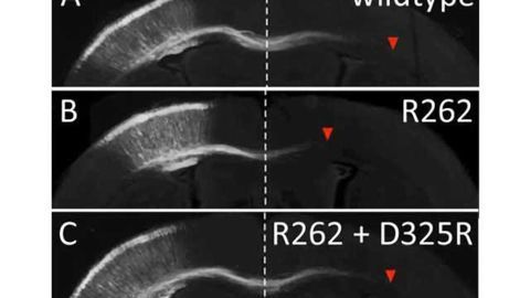 Thwarting abnormal neural development with a new mutation