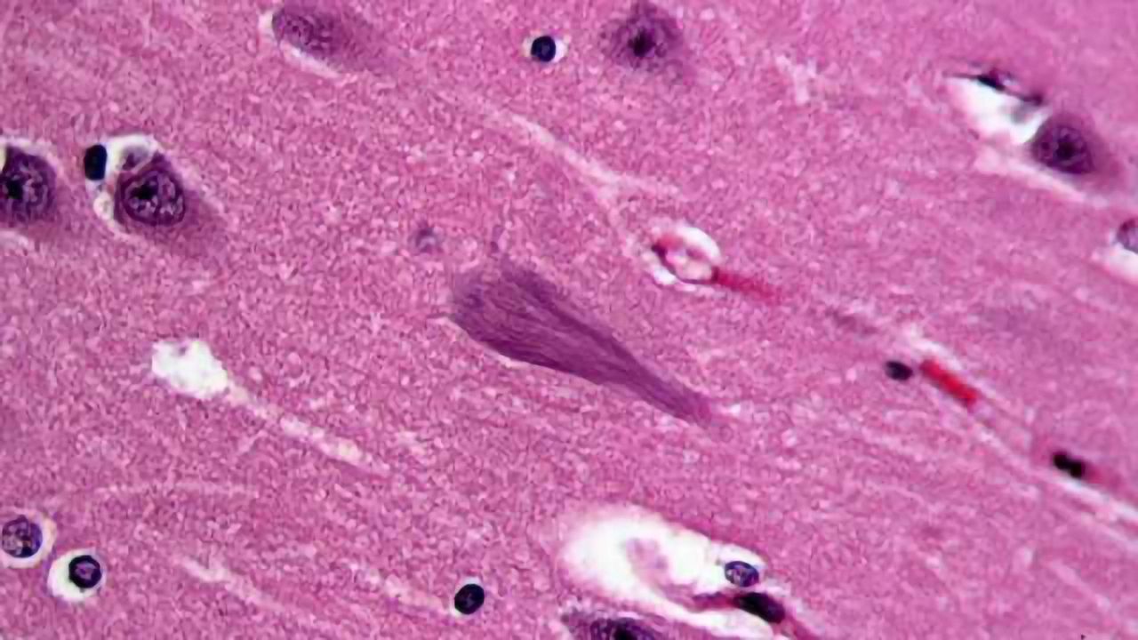 Environmental toxin may increase risk of Alzheimer's & other neurodegenerative illnesses