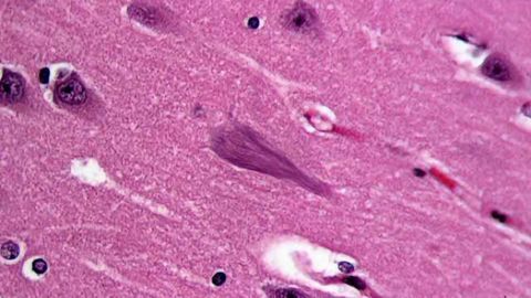 Environmental toxin may increase risk of Alzheimer's & other neurodegenerative illnesses