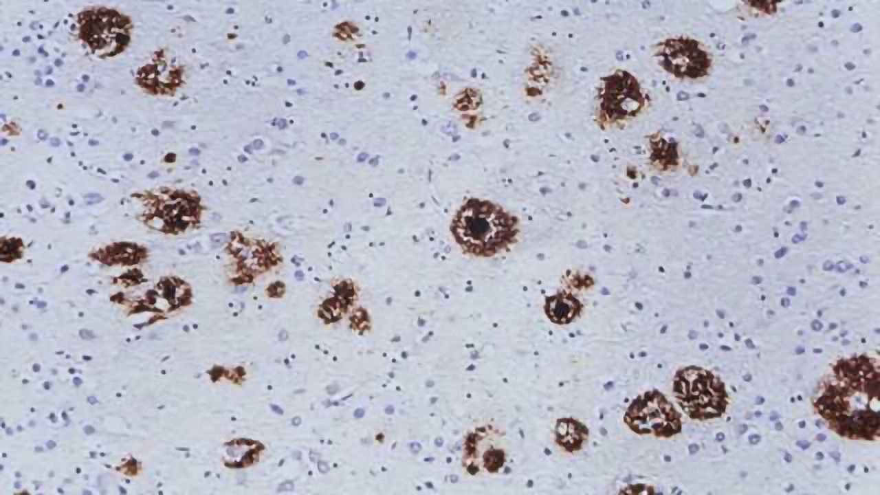 Alzheimer-type brain pathology after transplantation of dura mater