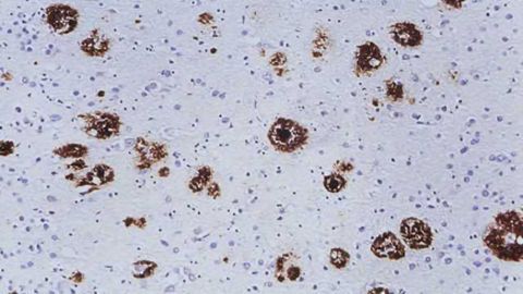 Alzheimer-type brain pathology after transplantation of dura mater