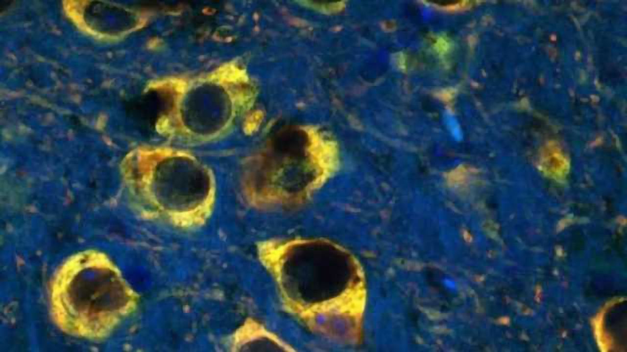 The connection between excess iron and Parkinson's disease