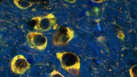 The connection between excess iron and Parkinson's disease