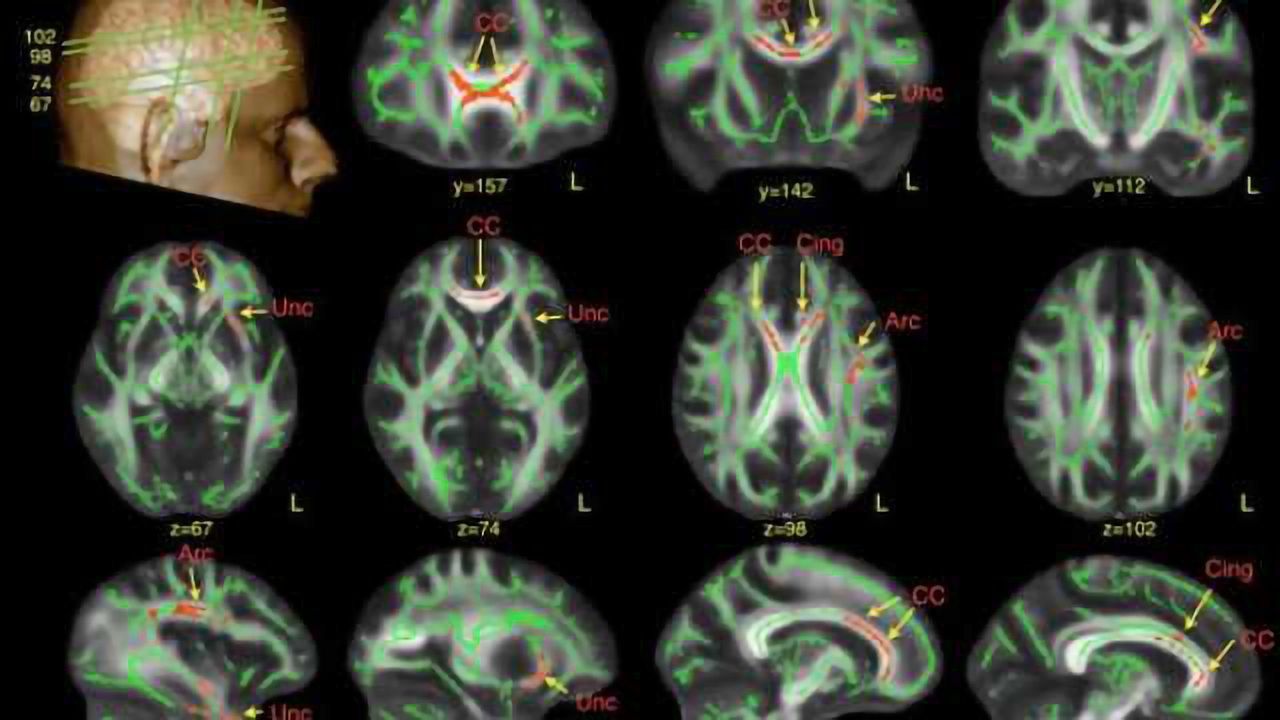 Study reveals subtle brain differences in men with autism